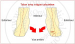 Talonnettes Supinatrices pour chaussures de ville 2