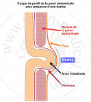 Ceinture herniaire INGUISTAR pour Homme et Femme 4